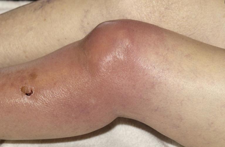 关节积液滑膜炎怎么治疗好得快,滑膜炎膝盖积水怎么治疗好得快