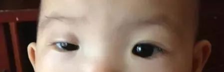 一单一双眼皮就不对称,左右眼皮不对称一单一双叫什么