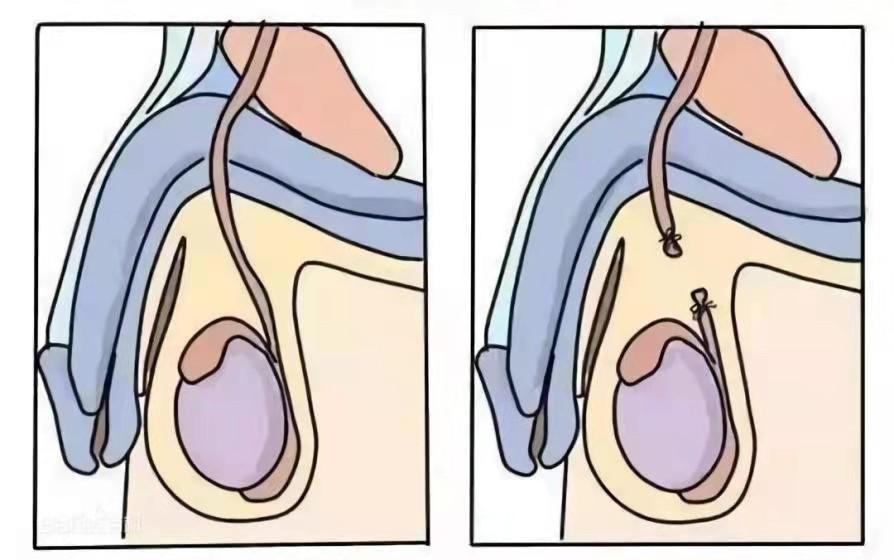 丈夫结扎妻子怀孕,太扎心男子2次结扎妻子怀孕