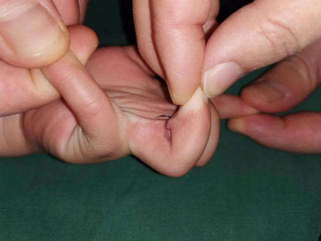 孩子被跑步机擦伤怎么处理,宝宝被跑步机磨掉了皮怎么护理