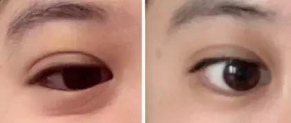 对眼纹有效果的眼霜推荐女生,年纪轻轻眼睛周围长细纹