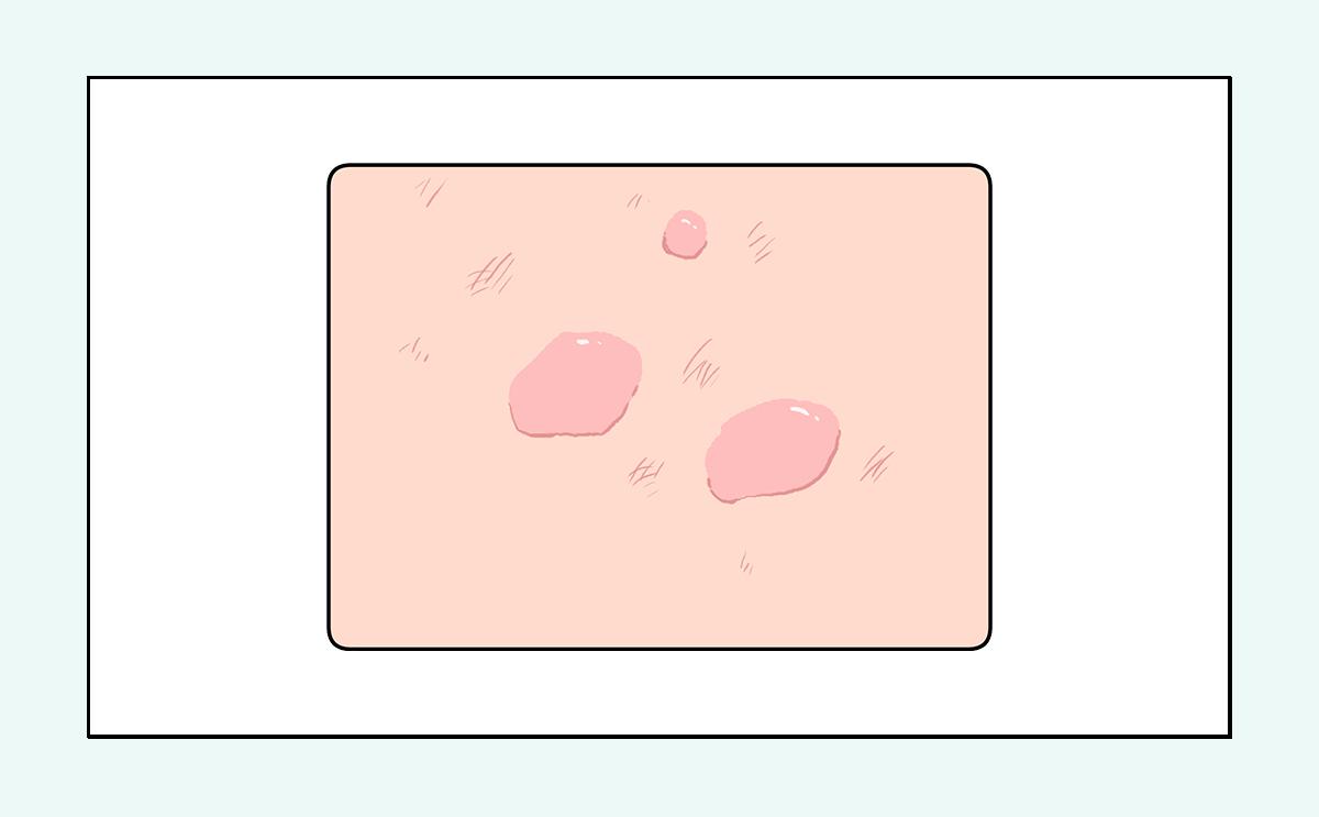 脸上的红疙瘩痒,脸上的红疙瘩用什么药膏