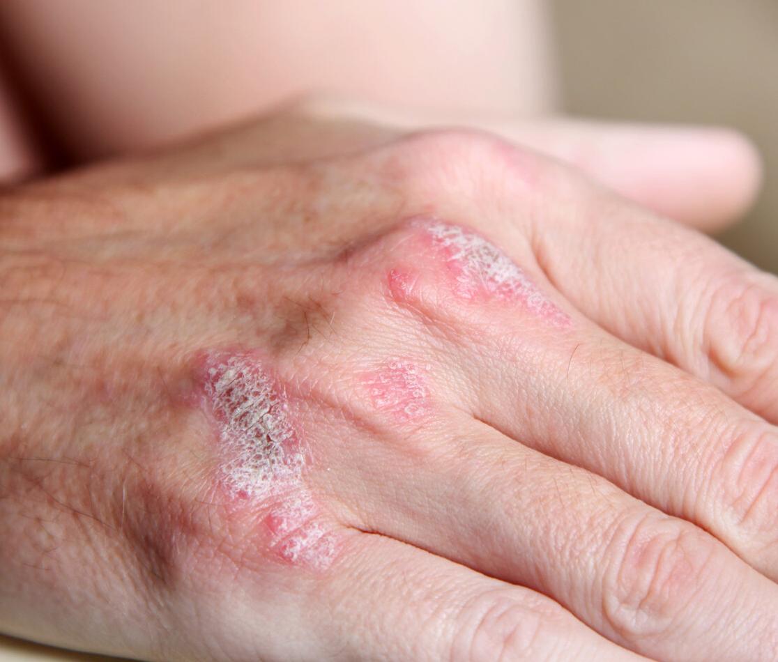 最近皮肤干燥又粗糙是什么原因,脸部皮肤干燥脱皮是什么原因