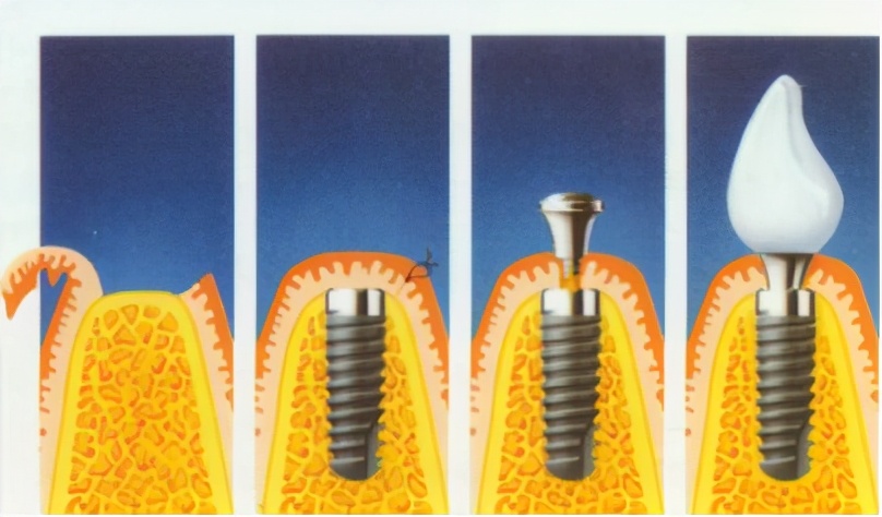选择一个好的口腔种植牙,口腔种植牙了解一下