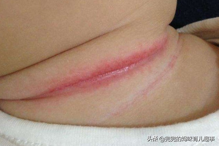 宝宝反反复复淹脖子怎么办,宝宝淹脖子反反复复不好怎么办