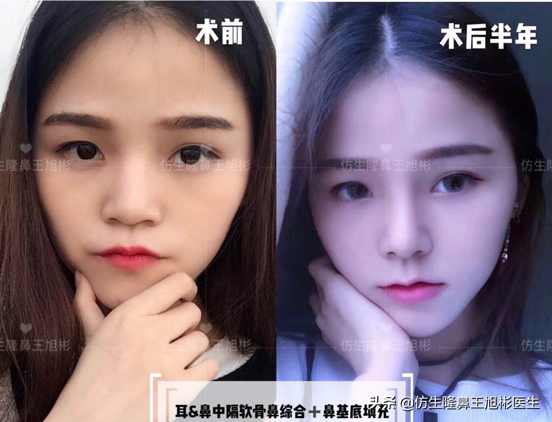 短鼻延长的最佳方法,短鼻修复前后对比案例