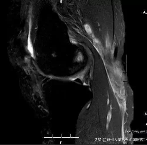 腘窝囊肿用针灸和蜡疗能治好吗,腘窝囊肿手术切口如何选择