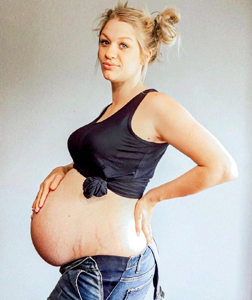 为什么女人怀孕会出现妊娠纹？和胎儿发育有关，教孕妈5招不长纹