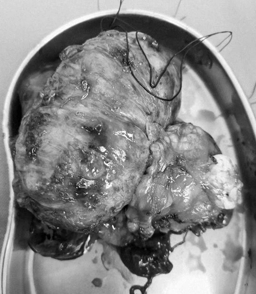 年纪大的恶性胸腺瘤建议做手术吗,30多岁胸腺瘤影响生命