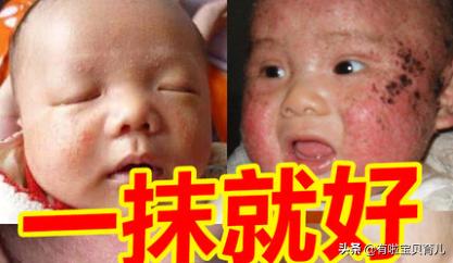 一擦就好？别被骗了！湿疹膏这样选、这样用才靠谱！