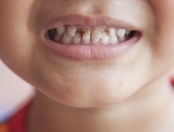小孩牙齿过稀怎么办,小孩牙齿磨损不能吃什么