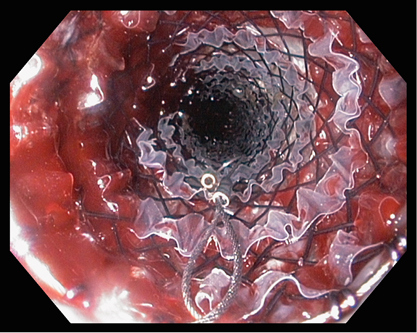 肠癌引起肠梗阻最佳中医治疗方法,肠癌引起的肠梗阻如何治疗