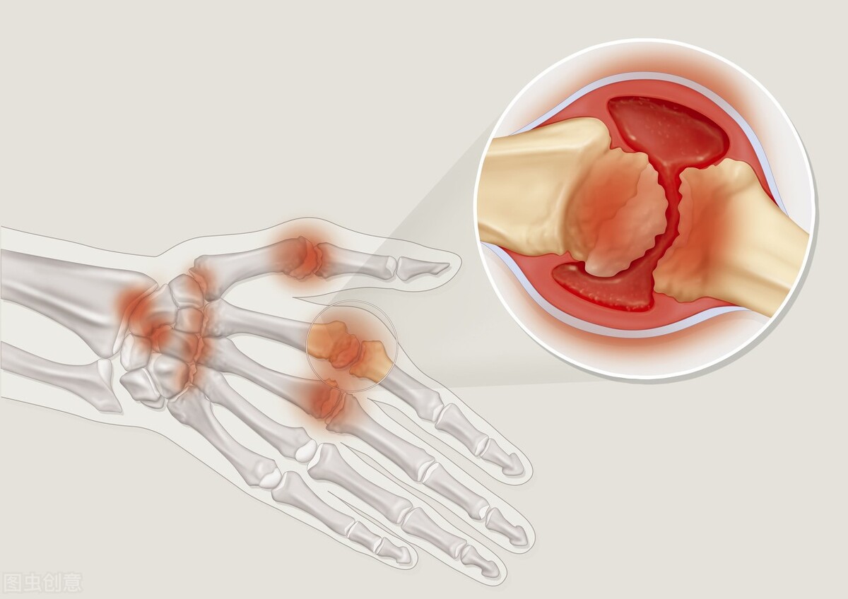 类风湿关节炎早期发现治疗能好吗,早期类风湿关节炎彻底治愈率