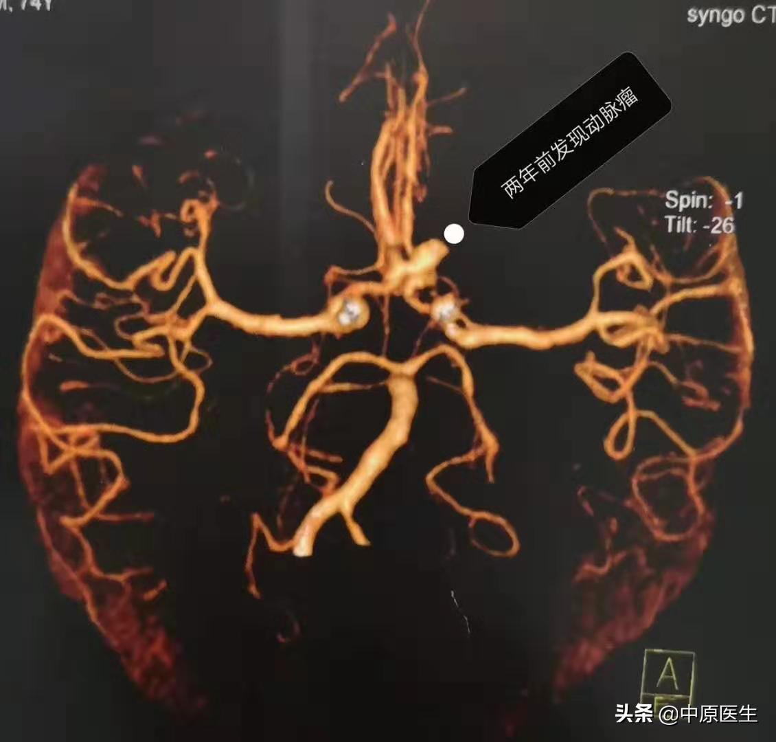 大脑双侧动脉瘤,发现脑内有两个瘤医生说不管