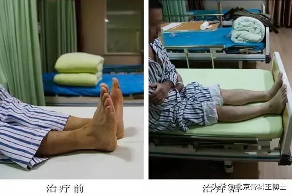 股骨头坏死,股骨头坏死前期锻炼能自愈吗