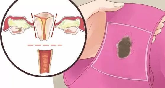 女孩多大接种hpv效果最好,女生多少岁打hpv疫苗合适