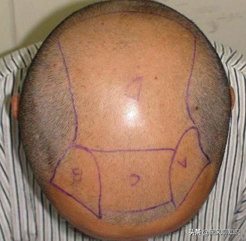 为头发祈福，日本为防止秃头丧心病狂！100年后，秃顶才是归宿？