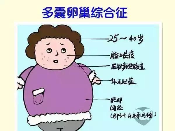 小马健身｜多囊卵巢综合征表现及预防治疗相关问题