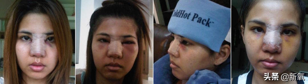 18岁土肥圆豪掷800万全身整形，鼻子6次大整假体穿出，效果却超美