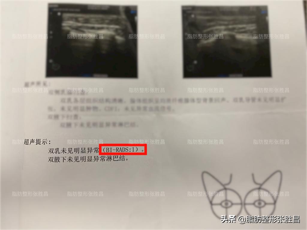 自体脂肪隆胸真实吗,有乳腺结节可以做自体脂肪隆胸吗