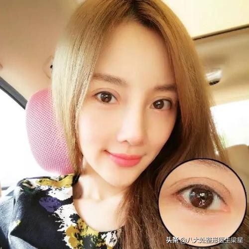 双眼皮手术开眼角恢复过程,双眼皮全切开眼角恢复期图