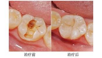 补个牙怎么要跑好几趟？太麻烦了吧，能一次搞定嘛！