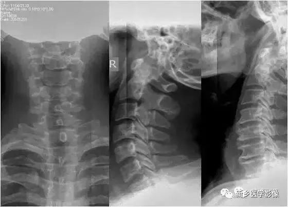 肘关节x线解剖,颈椎x线图片与讲解大全