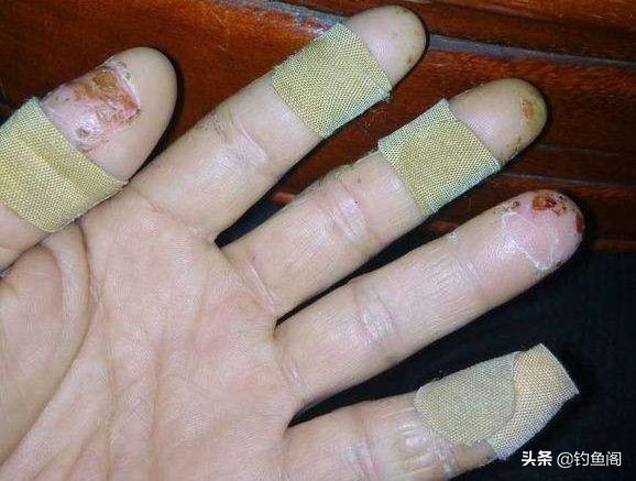 钓鱼香虎手能彻底根除吗,香虎手治好后还能钓鱼吗