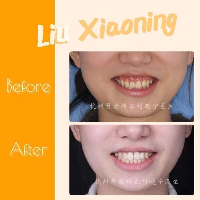矫正牙齿如何改善露龈笑,矫正牙齿可以改善露龈笑吗