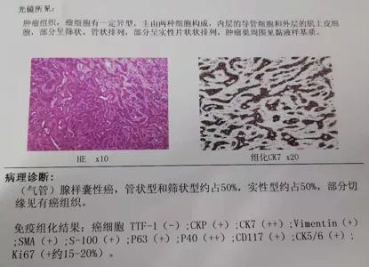 儿童90%为良性,成人却不到10%?患者气短3年,胸部CT提示的气管肿物意味着什么?气管镜有何发现?