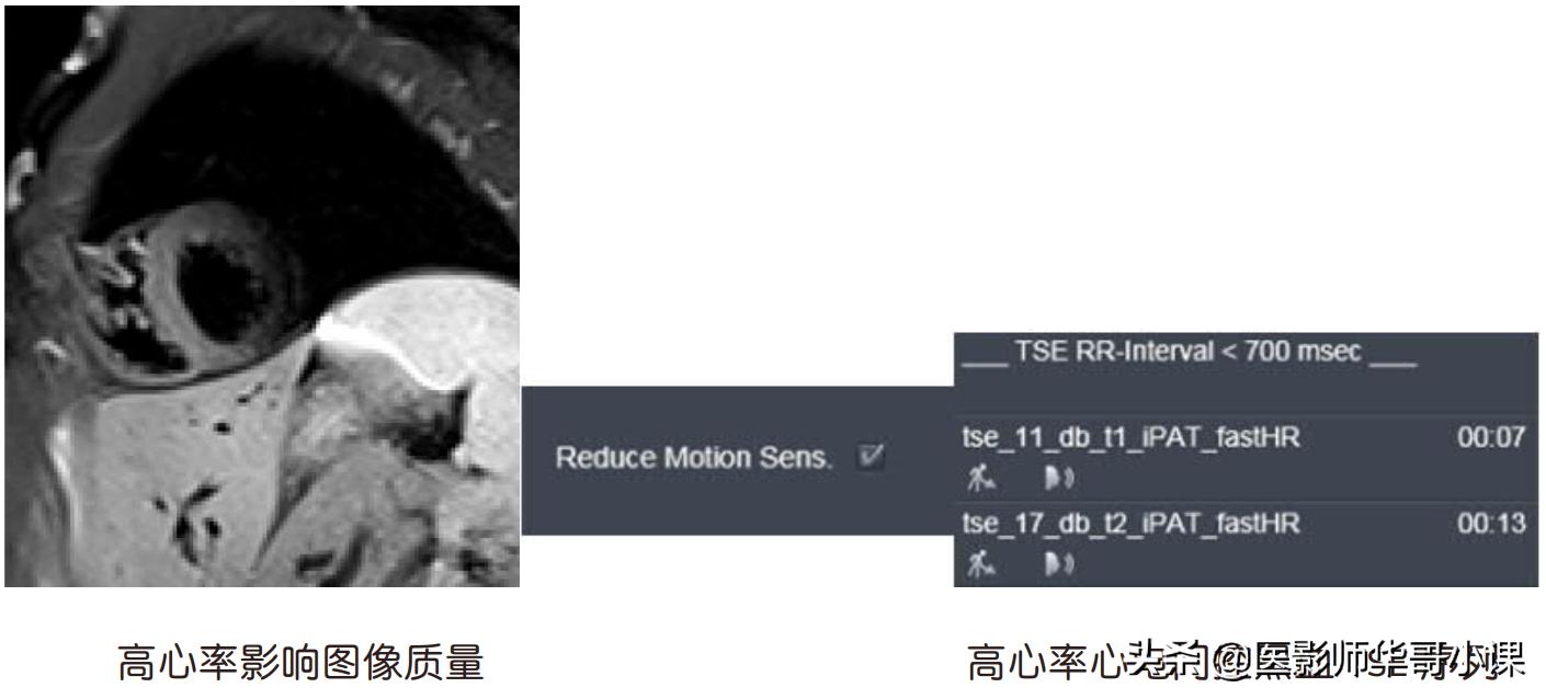 磁共振心脏扫描标准切面,心脏mri扫描定位