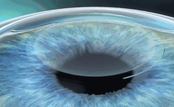 “近视手术毁了我”，他们选择自杀，原来这种手术比想象的危险！