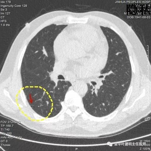 警惕-会是简单的肺大泡吗？