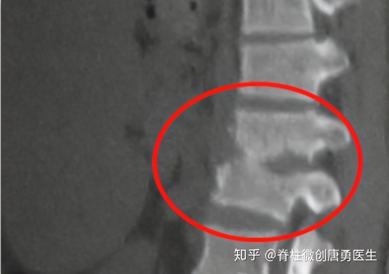 腰痛要警惕四种原因强直性脊柱炎,腰部脊柱结核是什么症状