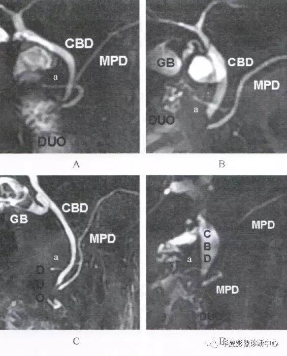 副胰管与主胰管图谱,主胰管型和分支胰管型如何鉴别