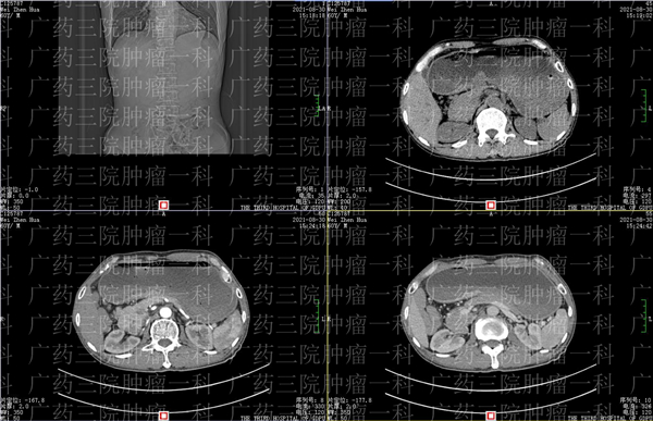 广药三院肿瘤综合治疗中心,广药三院肿瘤科治头颈癌吗