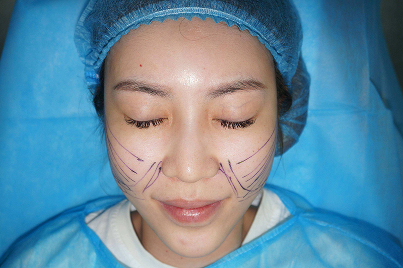 线雕面部提升是做什么的,面部线雕提升都做什么