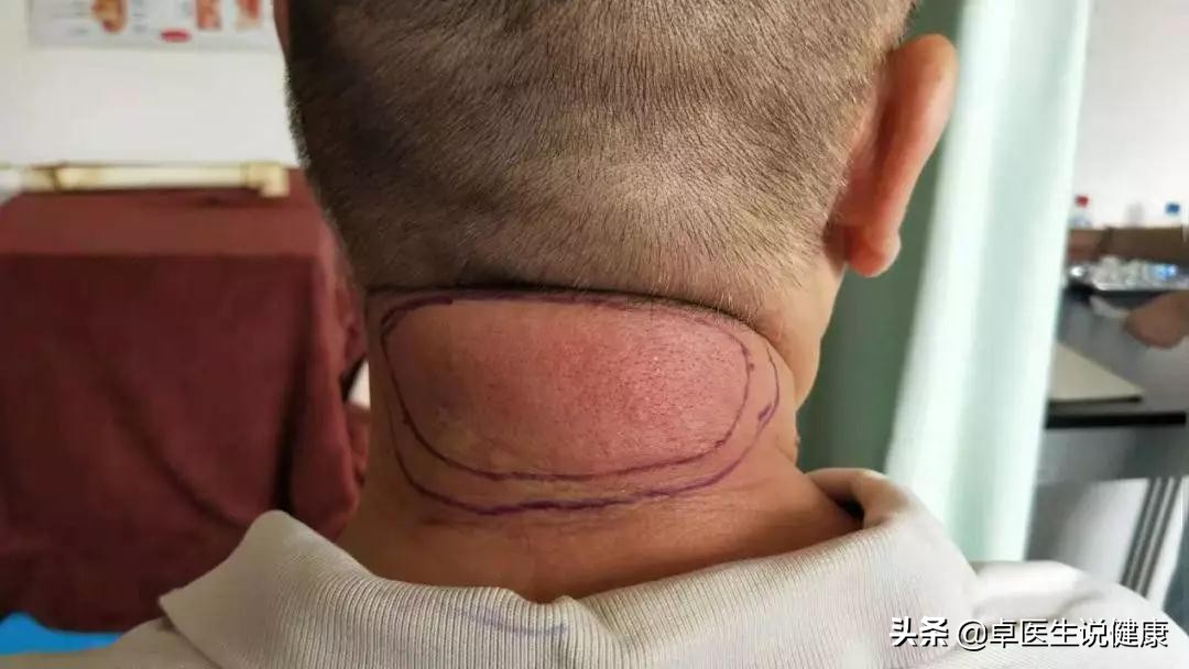 中医颊针案例分享:颈部包块20年,通过中医颊针疗法解决问题