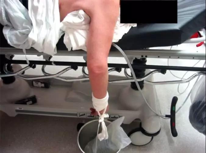 肩关节脱位怎么造成的,肩关节脱位的原因和急救方法