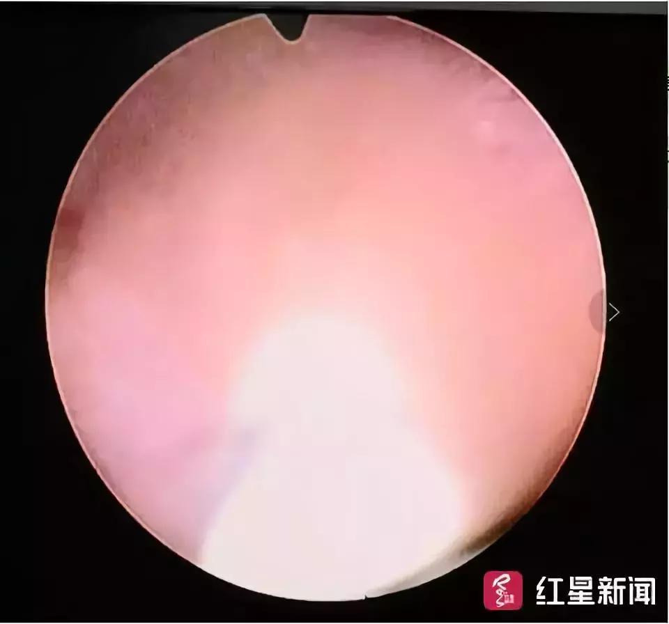 钙铁锌为什么要补三个月,钙铁锌几个月可以补