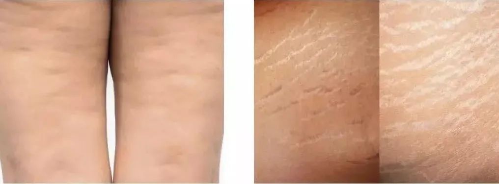 肥胖纹皮肤已经裂开了怎么办,为什么我明明不胖看起来却很胖