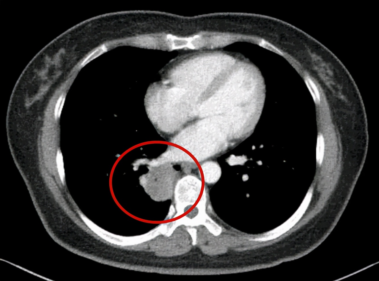 问诊分析：右下肺占位伴多发小结节，如何考虑？