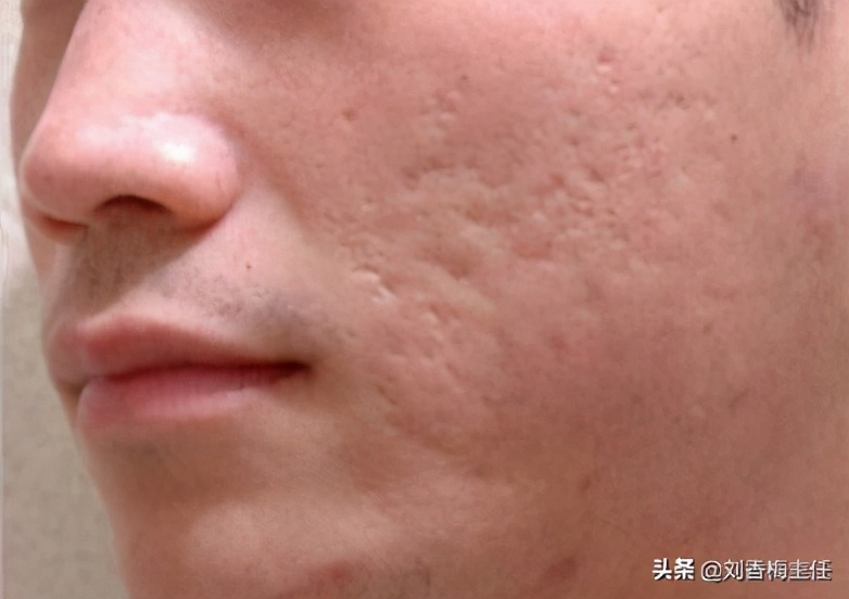 痘印痘坑对颜值的影响,严重的痘坑护肤可以修复吗