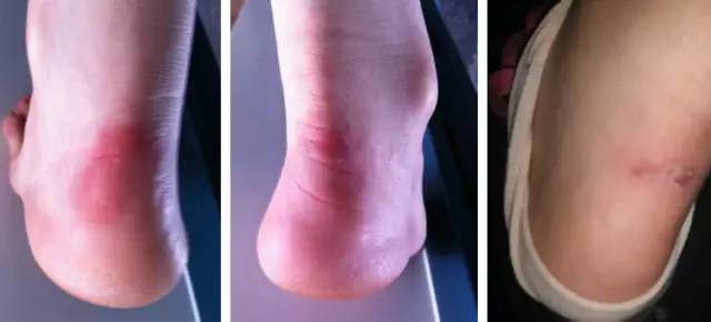 为什么女生的脚后跟那么容易磨破,脚后跟的心酸血泪史