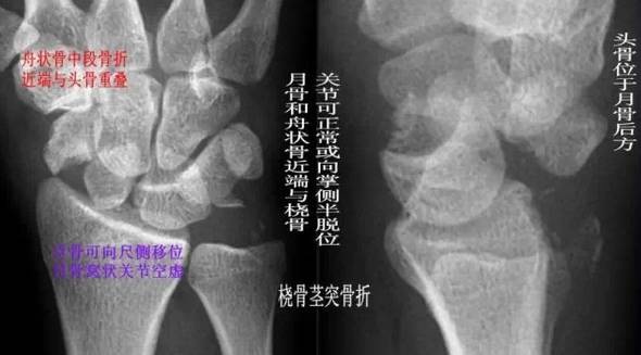 青少年尺腕关节脱位x线诊断标准,腕关节侧位x线片读片技巧
