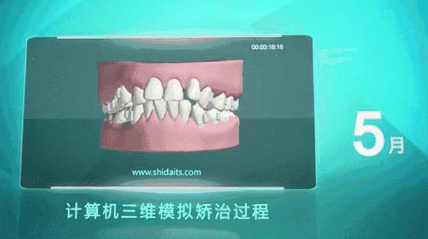 推广|身份证42开头的注意!牙齿矫正、种植牙,这些全免费!