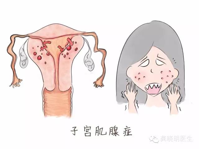 子宫内膜异位症——痛经的一种常见病因