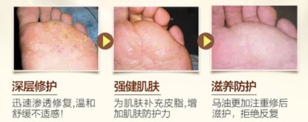 治疗脚气烂脚丫的小妙招,如何治疗脚臭脚气脚后跟开裂