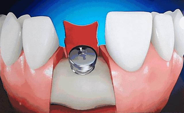 速看！11月起，这些新规实施，矫正牙齿、种植牙这些费用全免！