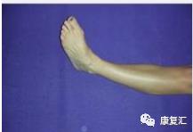 脚踝扭伤很痛怎么医,脚踝内侧筋痛扭伤详细康复训练